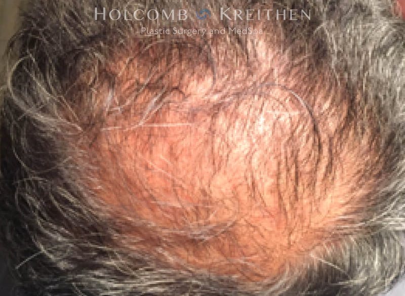 Neograft 2.0 Before & After Gallery - Patient 348289 - Image 1