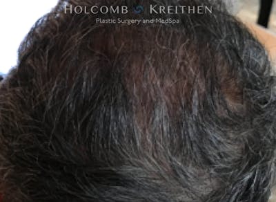 Neograft 2.0 Before & After Gallery - Patient 348289 - Image 2
