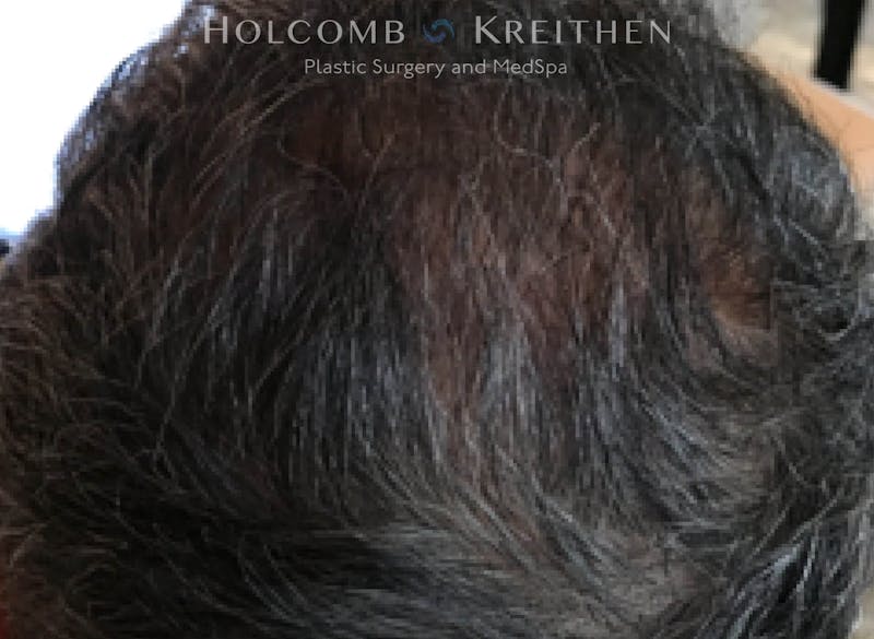 Neograft 2.0 Before & After Gallery - Patient 348289 - Image 2