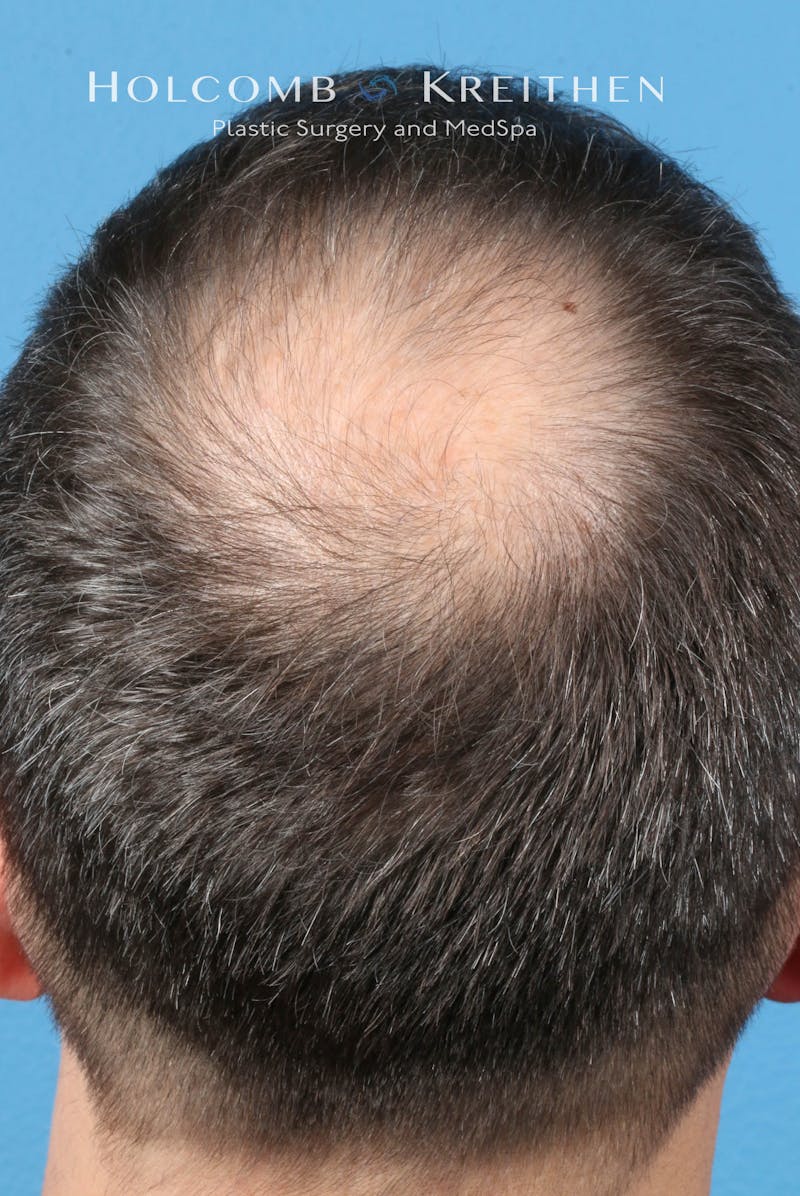 Neograft 2.0 Before & After Gallery - Patient 127727 - Image 1