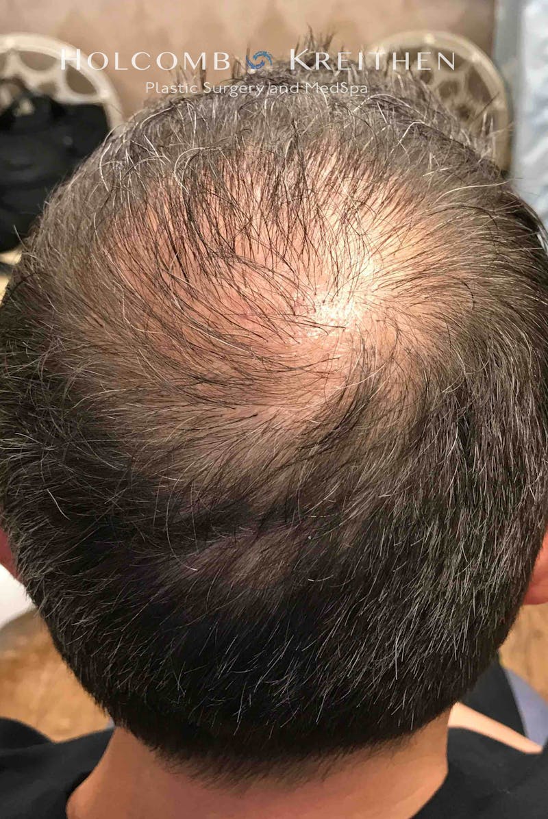 Neograft 2.0 Before & After Gallery - Patient 127727 - Image 2