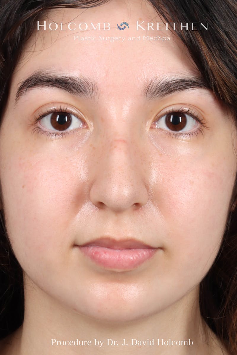 Rhinoplasty Before & After Gallery - Patient 207876 - Image 3