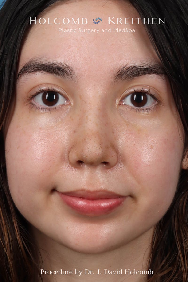 Rhinoplasty Before & After Gallery - Patient 207876 - Image 4
