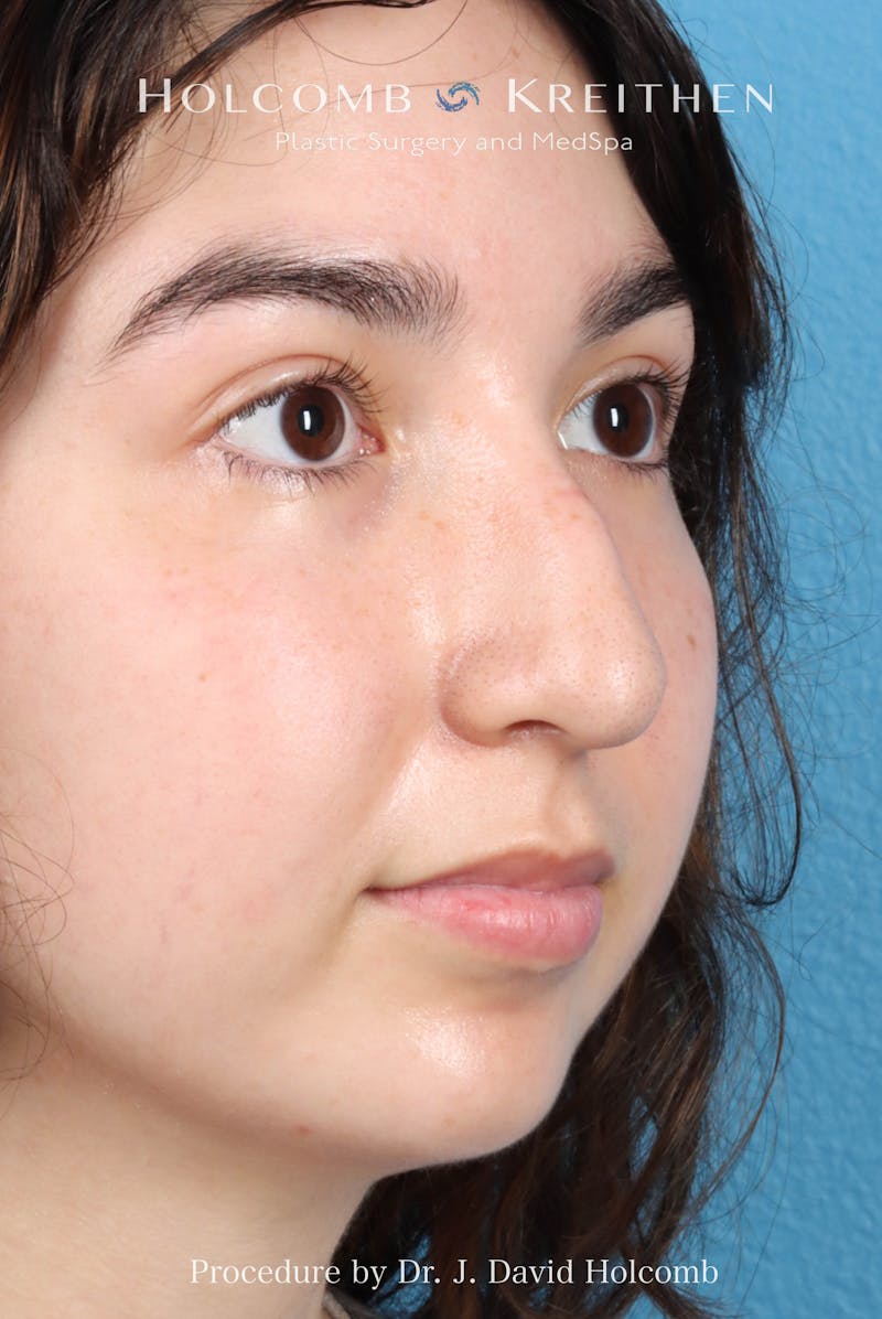 Rhinoplasty Before & After Gallery - Patient 207876 - Image 5