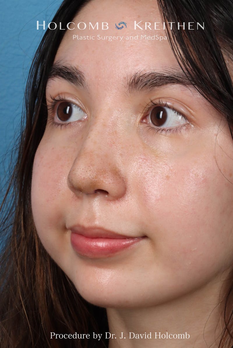 Rhinoplasty Before & After Gallery - Patient 207876 - Image 8