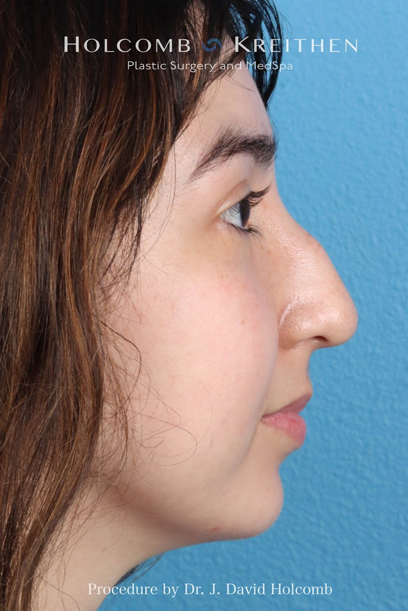 Rhinoplasty Before & After Gallery - Patient 207876 - Image 9