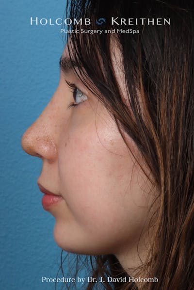 Rhinoplasty Before & After Gallery - Patient 207876 - Image 2