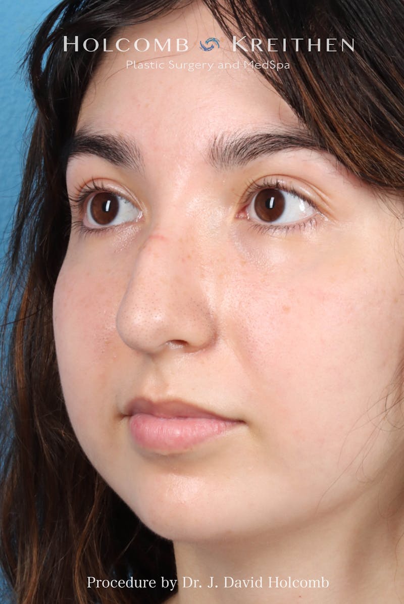 Rhinoplasty Before & After Gallery - Patient 207876 - Image 7