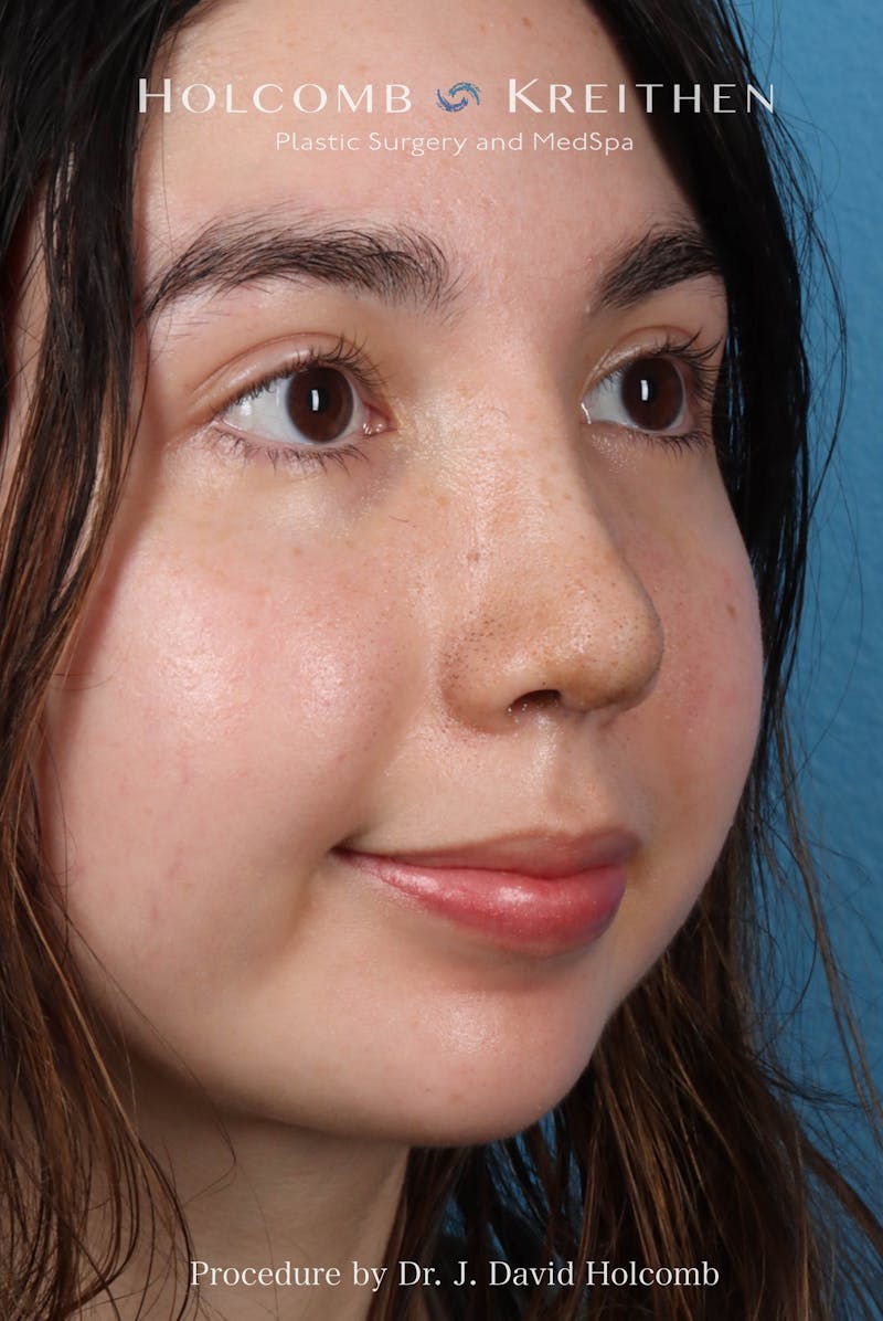 Rhinoplasty Before & After Gallery - Patient 207876 - Image 6