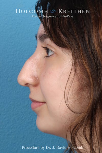Rhinoplasty Before & After Gallery - Patient 207876 - Image 1