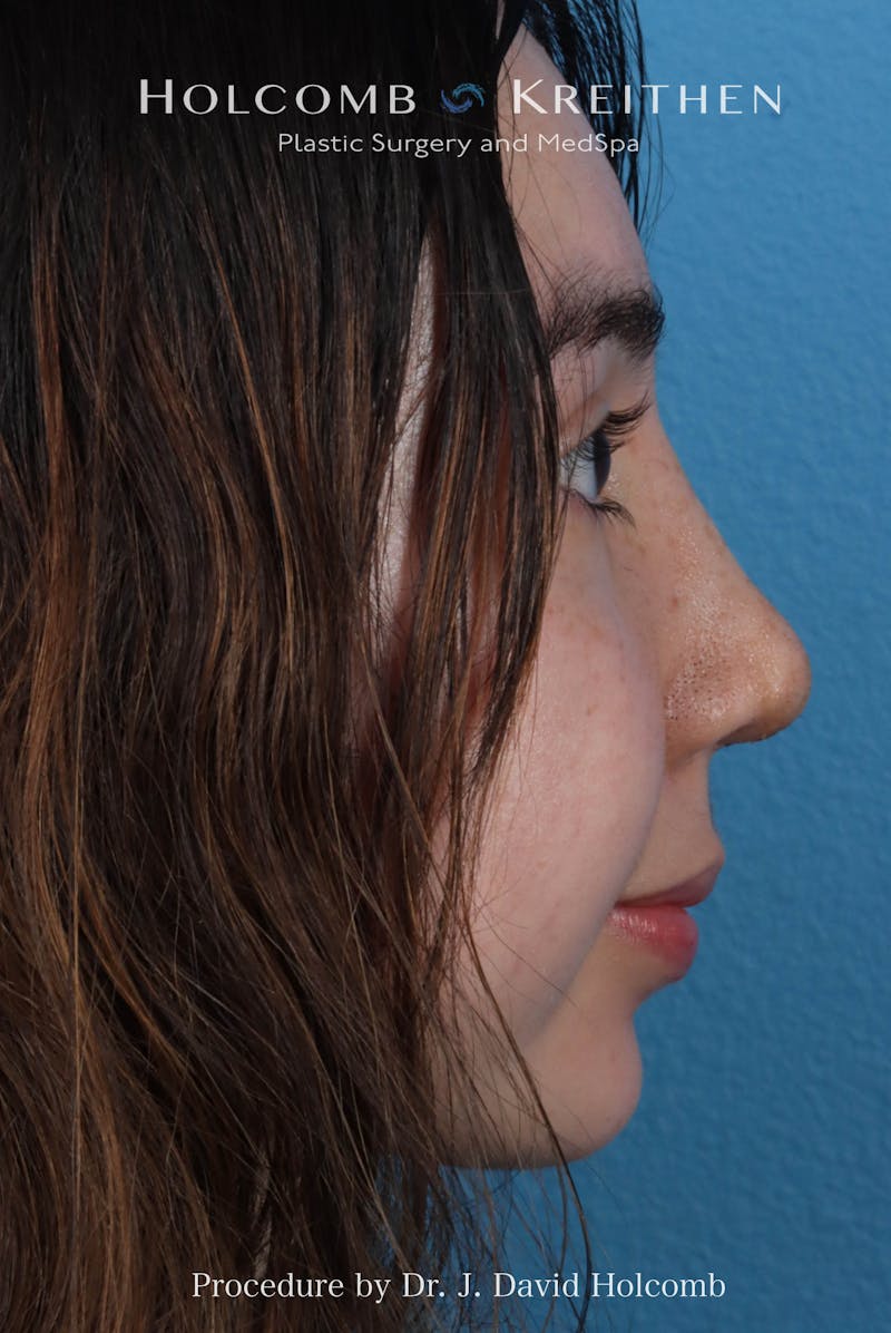 Rhinoplasty Before & After Gallery - Patient 207876 - Image 10