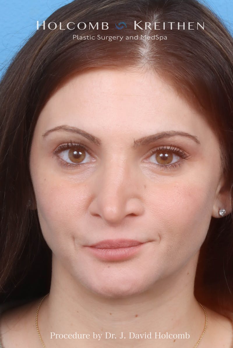 Rhinoplasty Before & After Gallery - Patient 181683 - Image 3