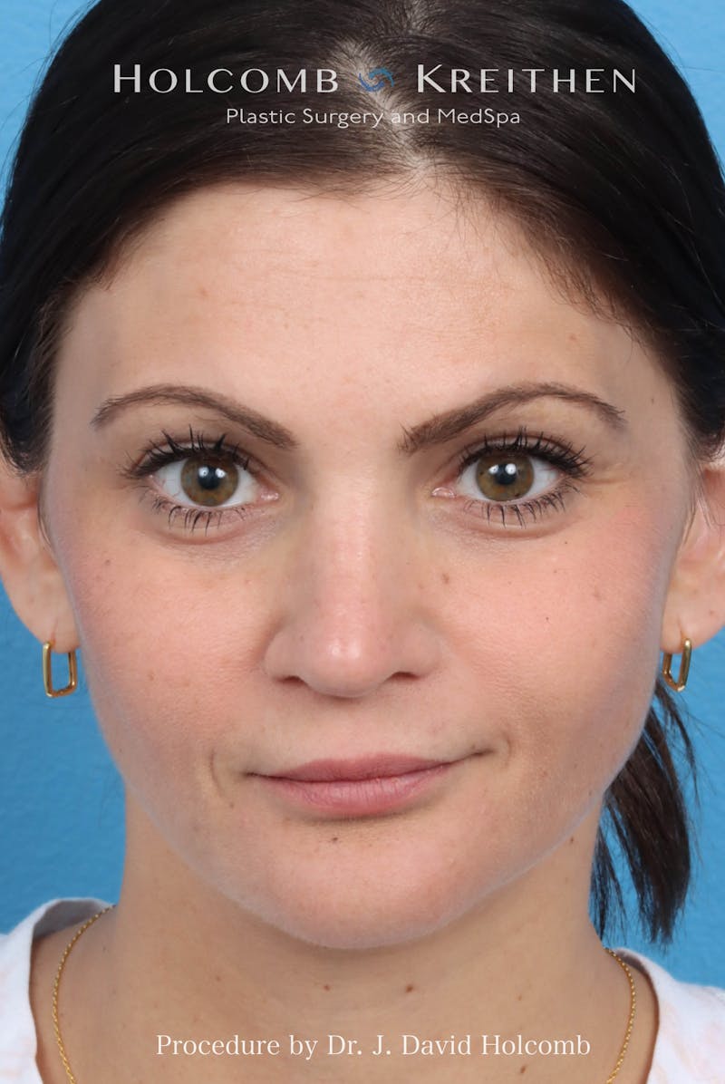 Rhinoplasty Before & After Gallery - Patient 181683 - Image 4