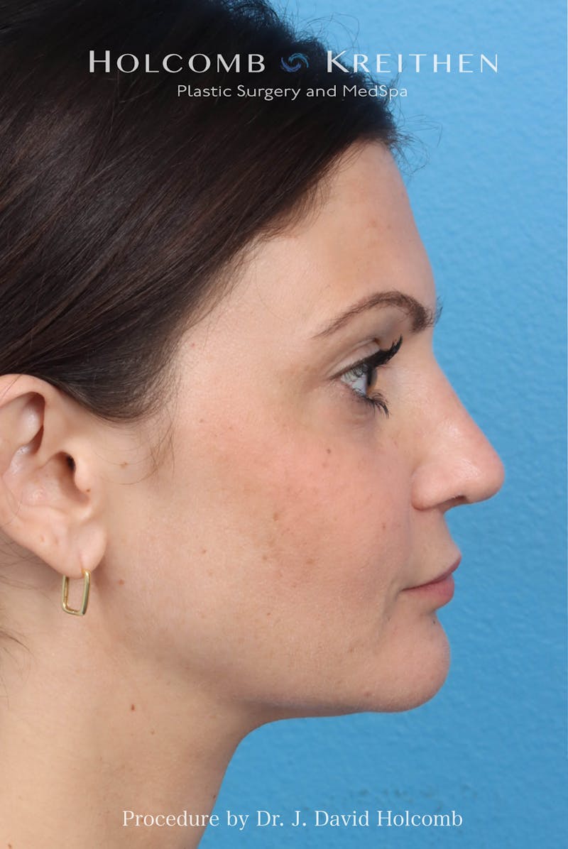 Rhinoplasty Before & After Gallery - Patient 181683 - Image 7