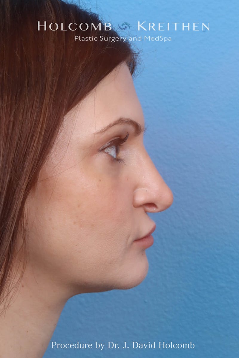 Rhinoplasty Before & After Gallery - Patient 181683 - Image 8