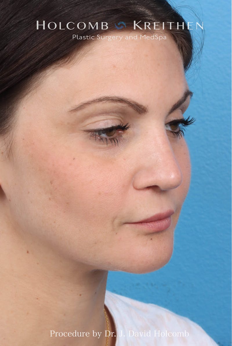 Rhinoplasty Before & After Gallery - Patient 181683 - Image 6