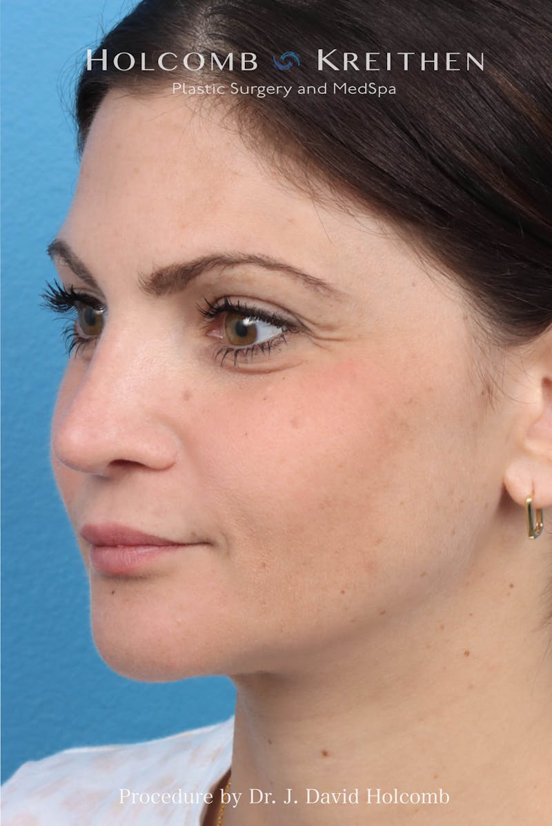 Rhinoplasty Before & After Gallery - Patient 181683 - Image 10