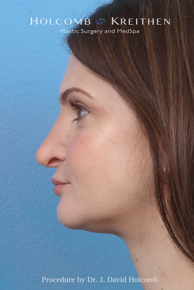 Rhinoplasty Before & After Gallery - Patient 181683 - Image 1