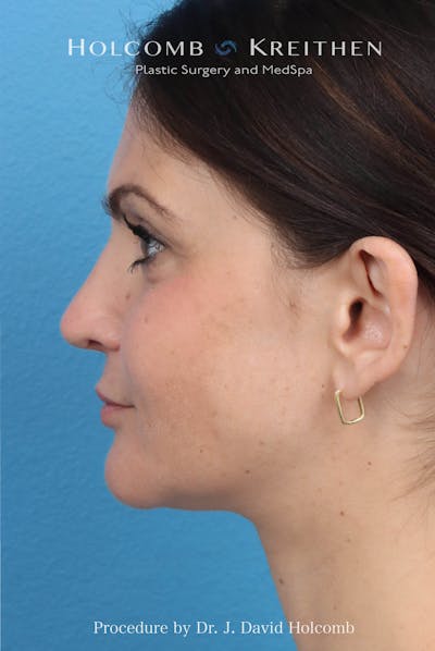 Rhinoplasty Before & After Gallery - Patient 181683 - Image 2
