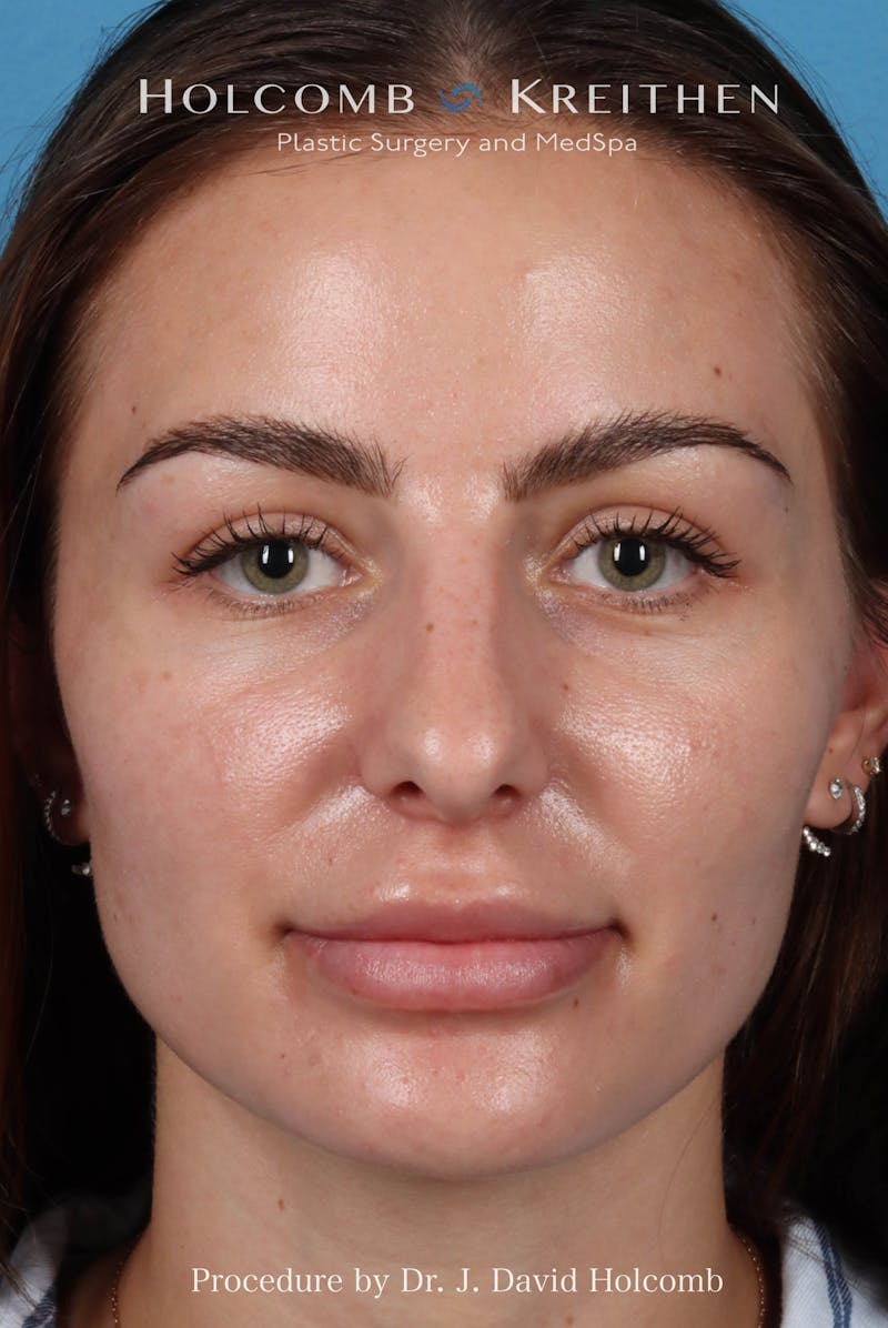 Rhinoplasty Before & After Gallery - Patient 301968 - Image 3