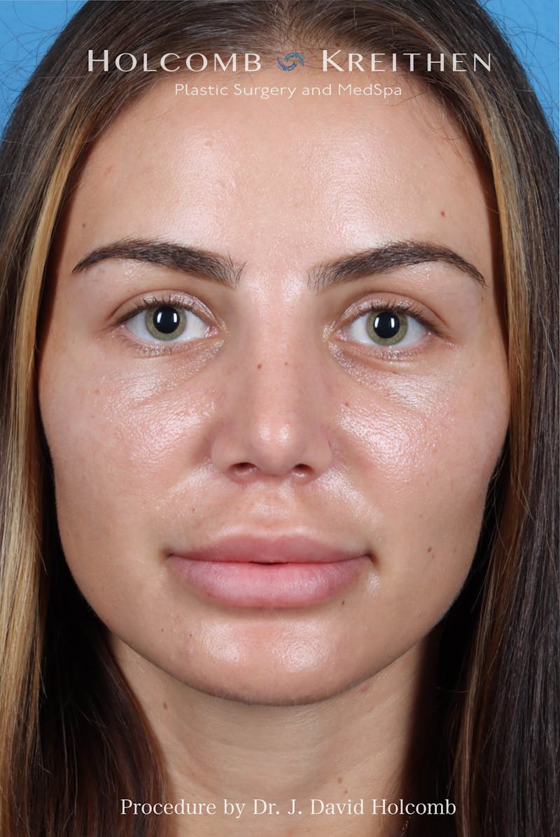 Rhinoplasty Before & After Gallery - Patient 301968 - Image 4