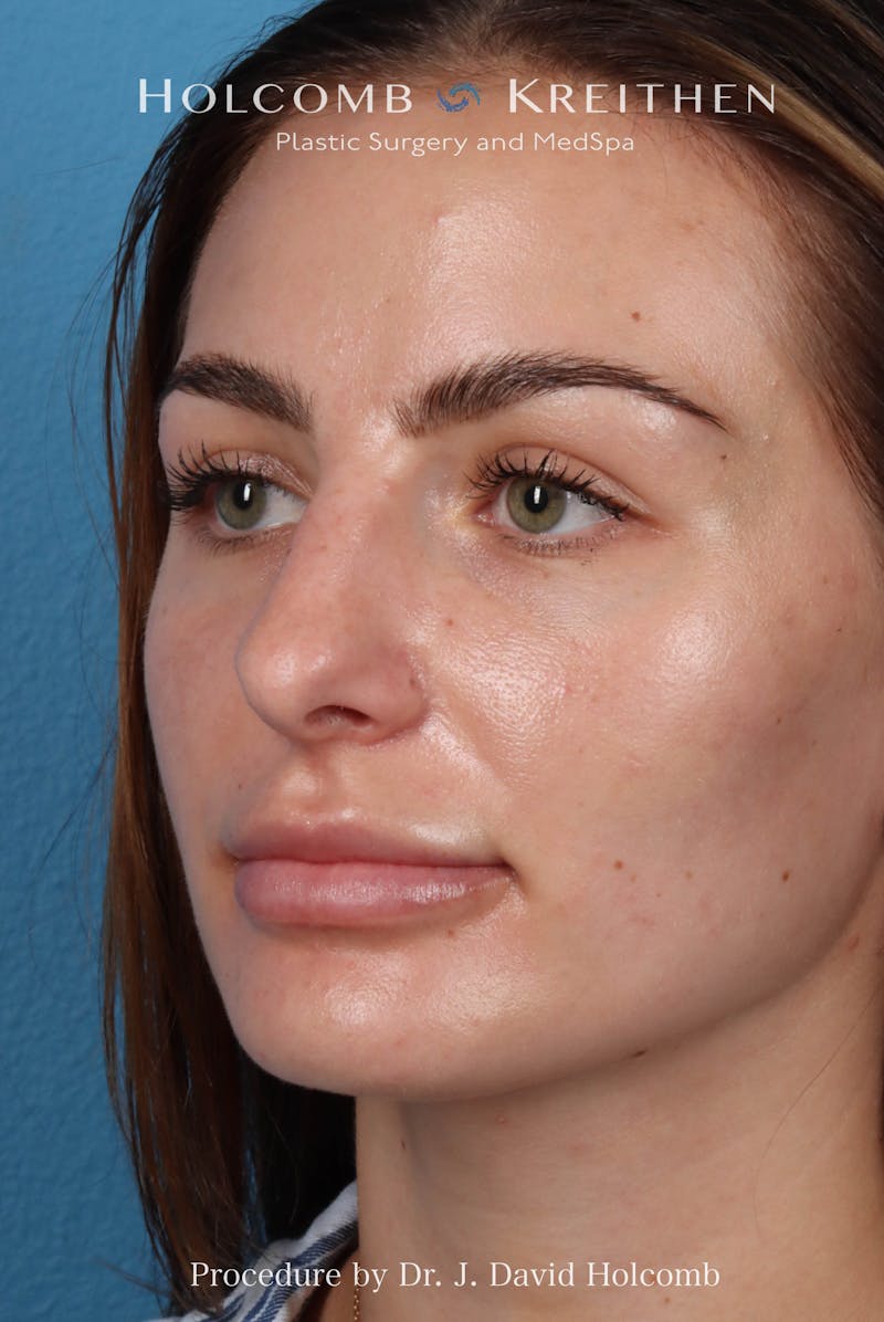 Rhinoplasty Before & After Gallery - Patient 301968 - Image 5