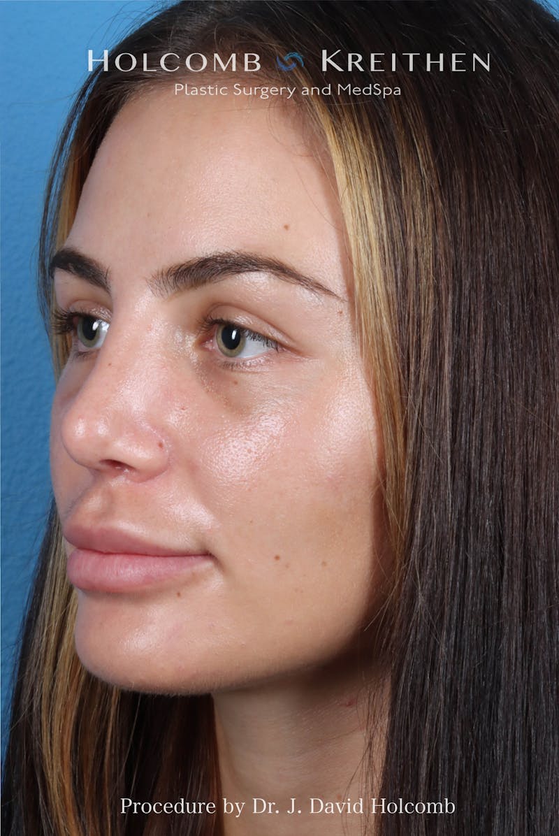 Rhinoplasty Before & After Gallery - Patient 301968 - Image 6