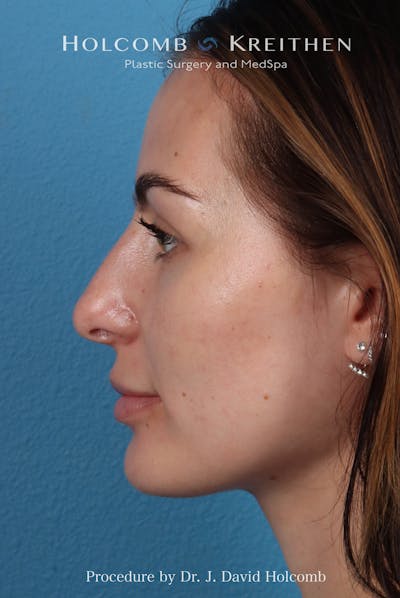 Rhinoplasty Before & After Gallery - Patient 301968 - Image 1