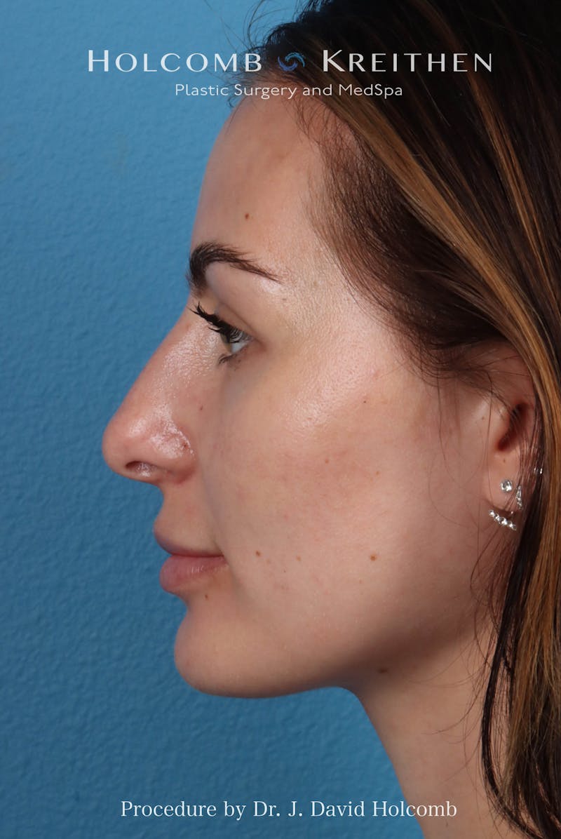 Rhinoplasty Before & After Gallery - Patient 301968 - Image 1
