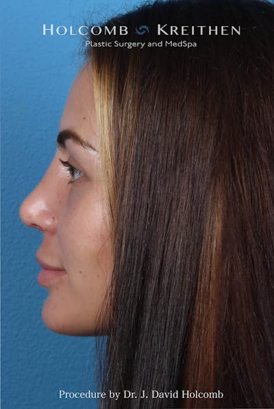 Rhinoplasty Before & After Gallery - Patient 301968 - Image 2