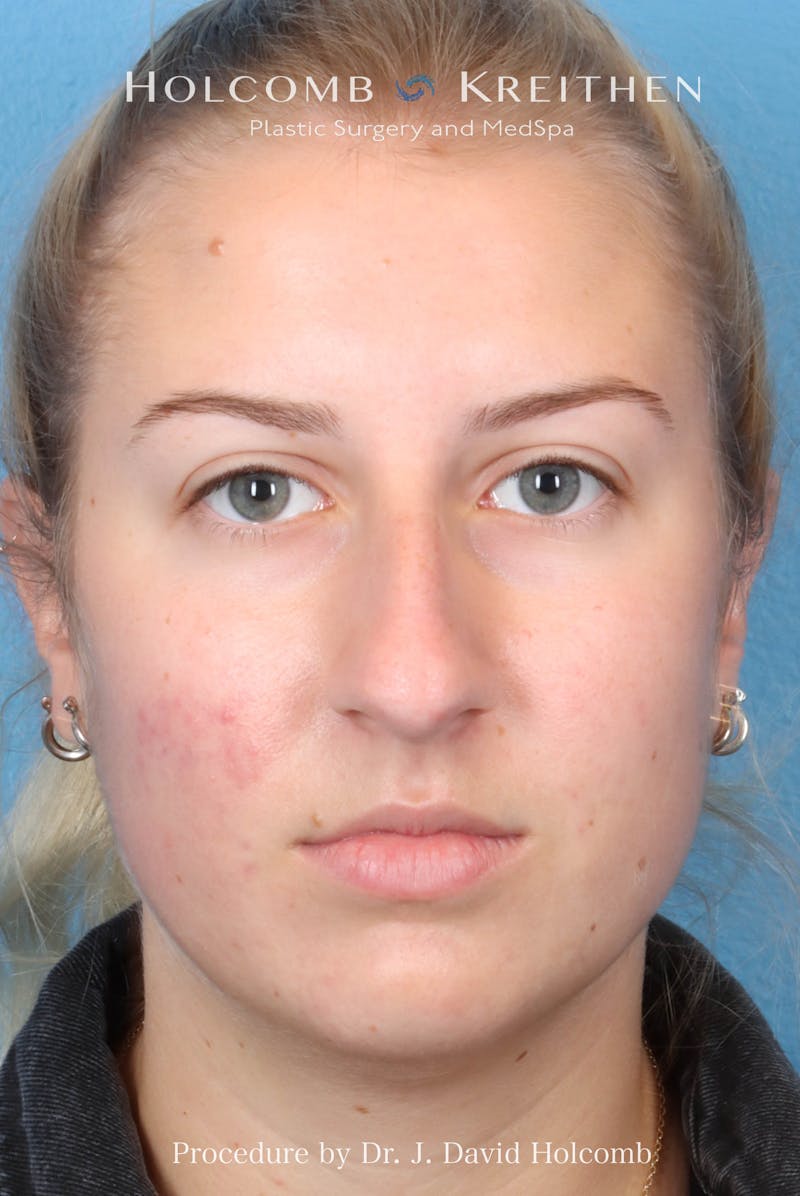 Rhinoplasty Before & After Gallery - Patient 125962 - Image 3