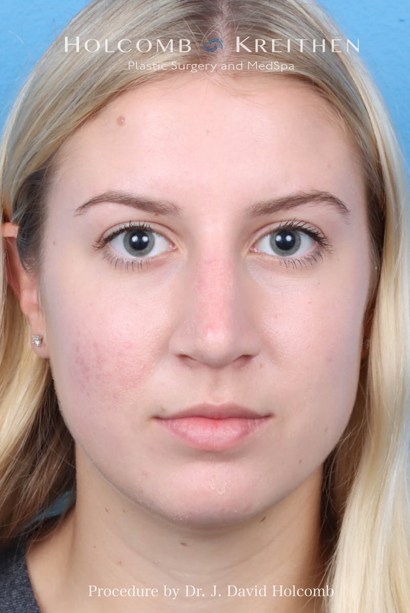 Rhinoplasty Before & After Gallery - Patient 125962 - Image 4