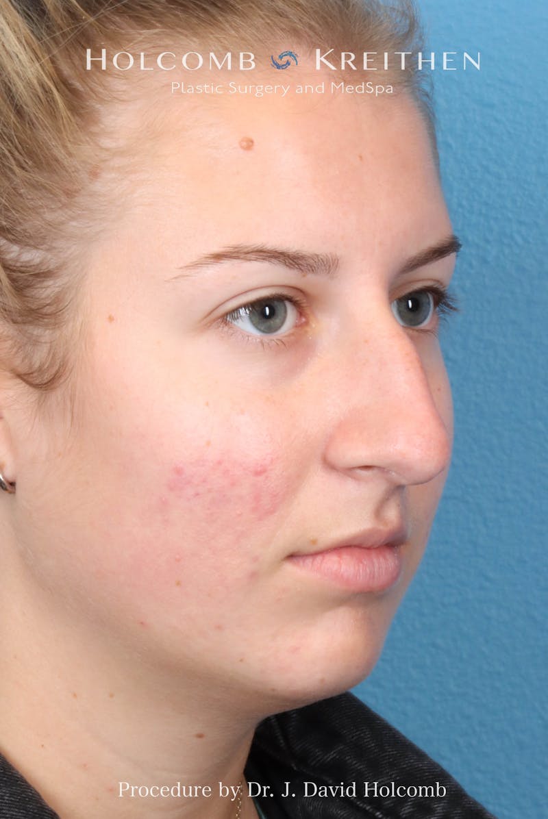 Rhinoplasty Before & After Gallery - Patient 125962 - Image 5