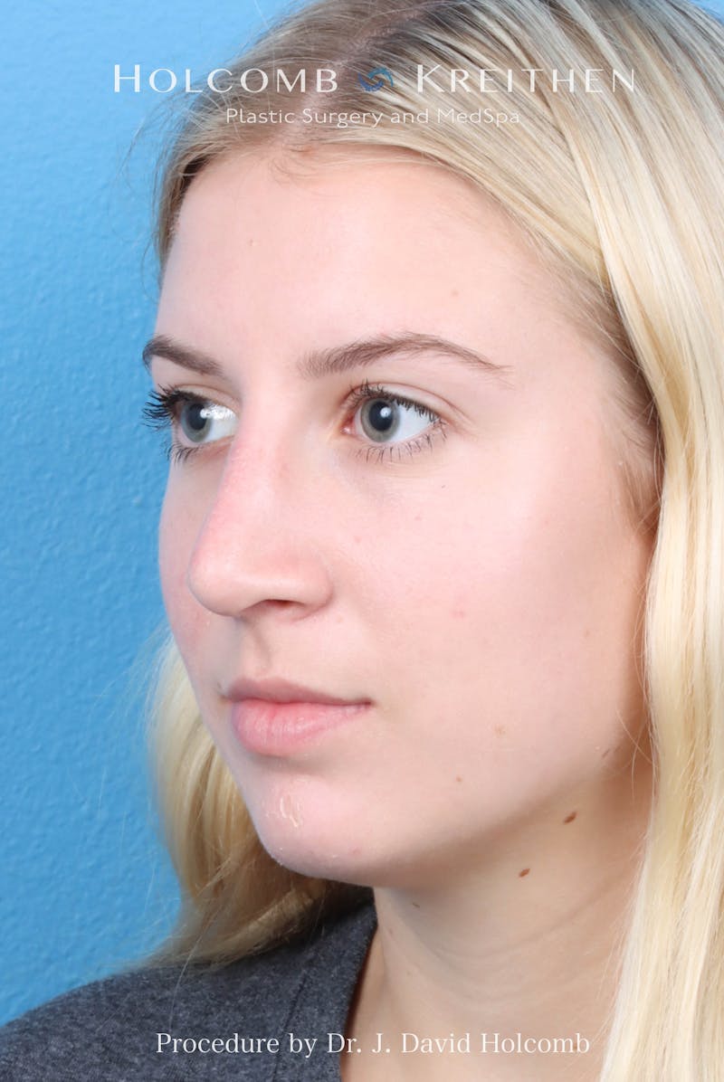 Rhinoplasty Before & After Gallery - Patient 125962 - Image 8