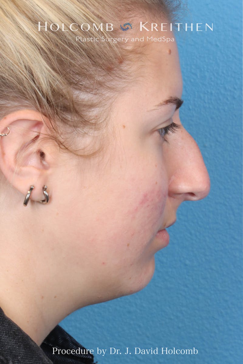 Rhinoplasty Before & After Gallery - Patient 125962 - Image 9