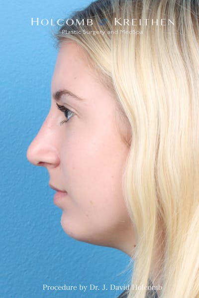 Rhinoplasty Before & After Gallery - Patient 125962 - Image 2