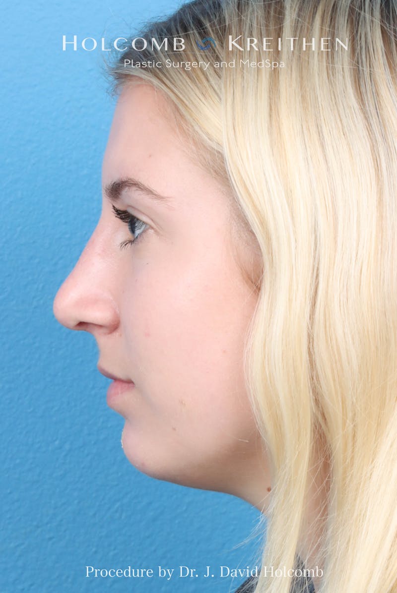 Rhinoplasty Before & After Gallery - Patient 125962 - Image 2