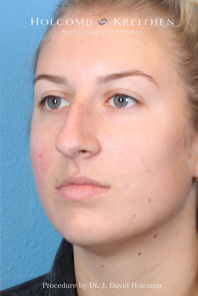 Rhinoplasty Before & After Gallery - Patient 125962 - Image 7