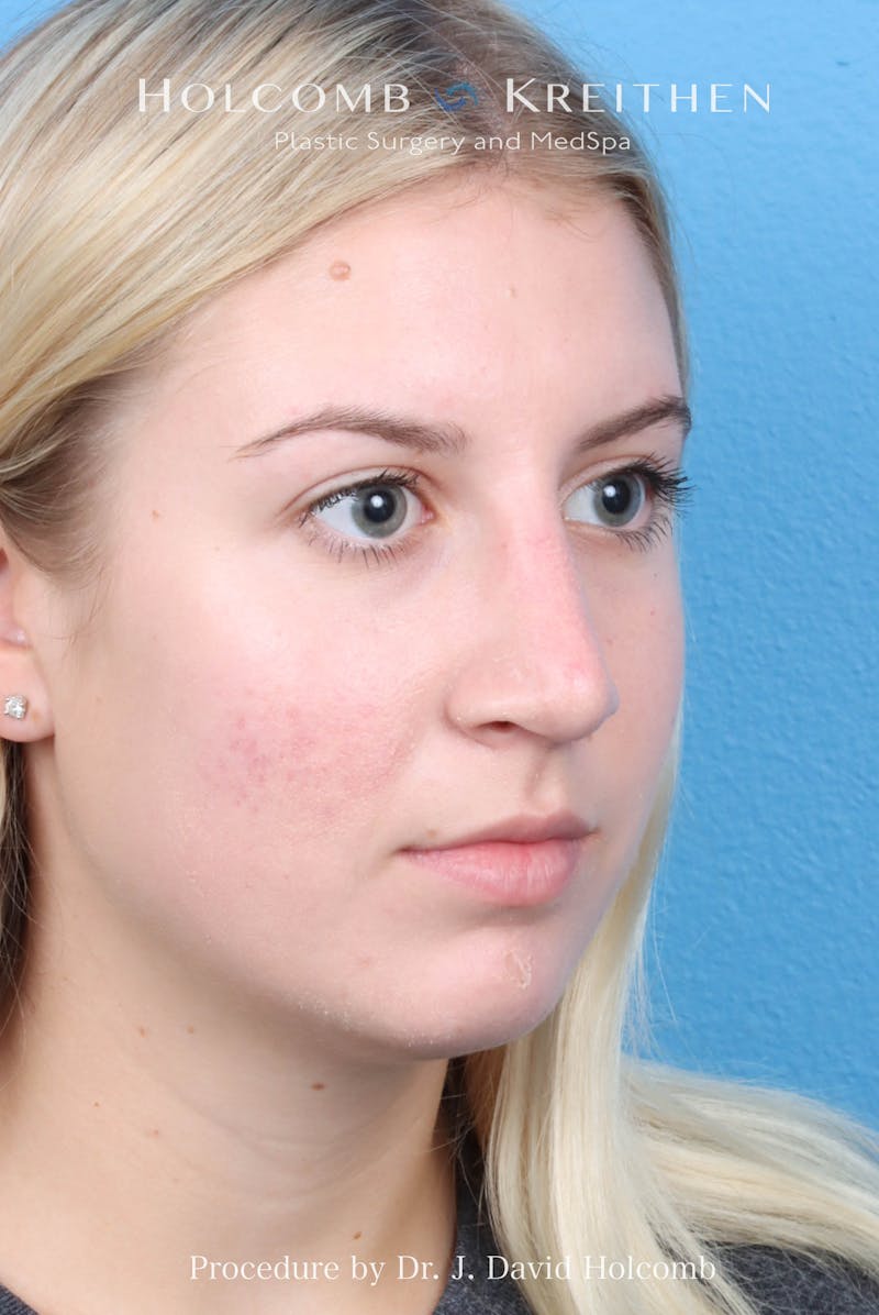 Rhinoplasty Before & After Gallery - Patient 125962 - Image 6