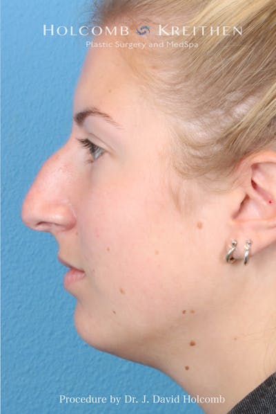Rhinoplasty Before & After Gallery - Patient 125962 - Image 1