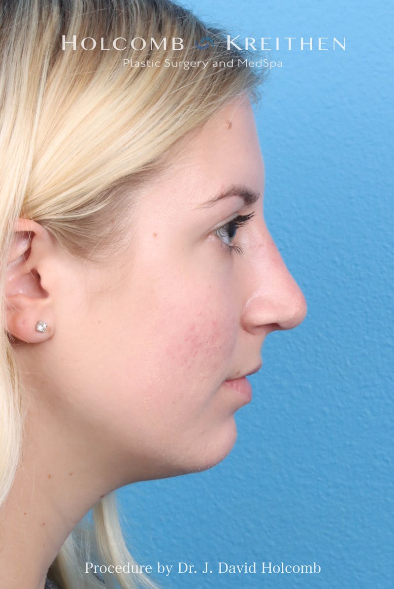 Rhinoplasty Before & After Gallery - Patient 125962 - Image 10