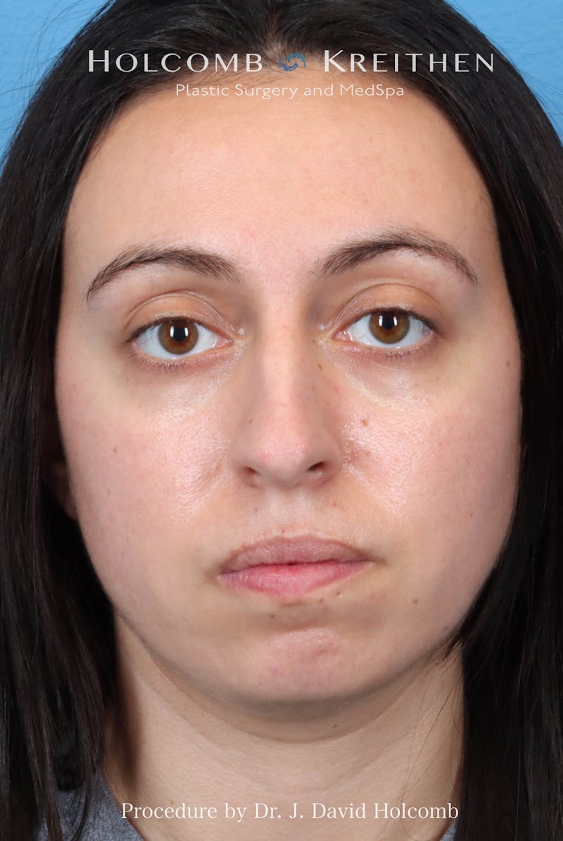 Rhinoplasty Before & After Gallery - Patient 804562 - Image 3