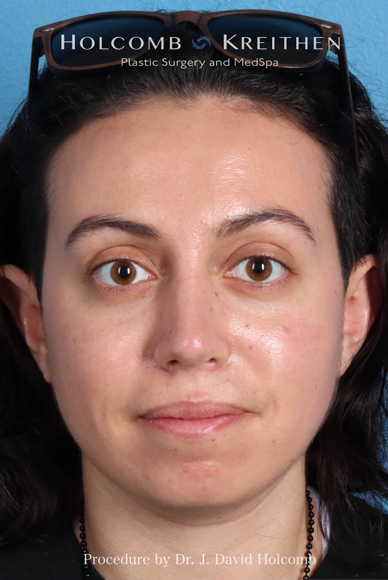 Rhinoplasty Before & After Gallery - Patient 804562 - Image 4