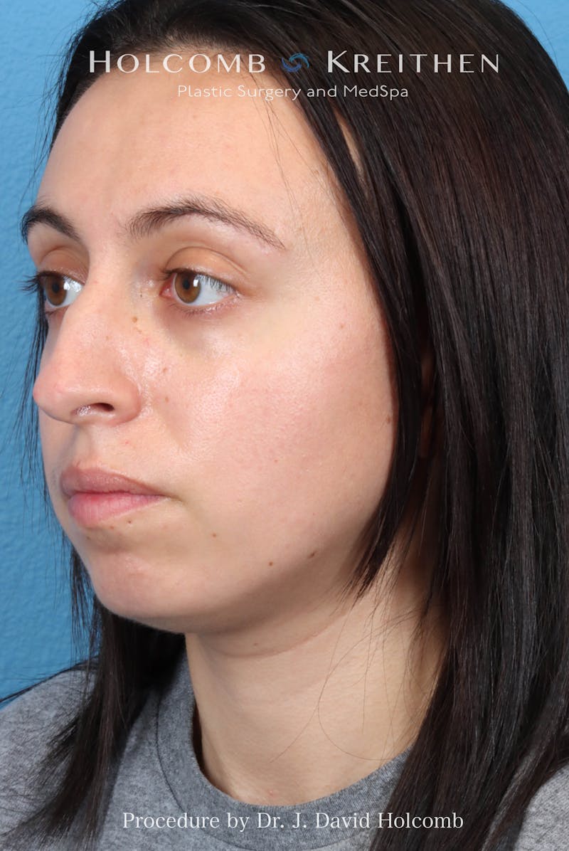 Rhinoplasty Before & After Gallery - Patient 804562 - Image 5