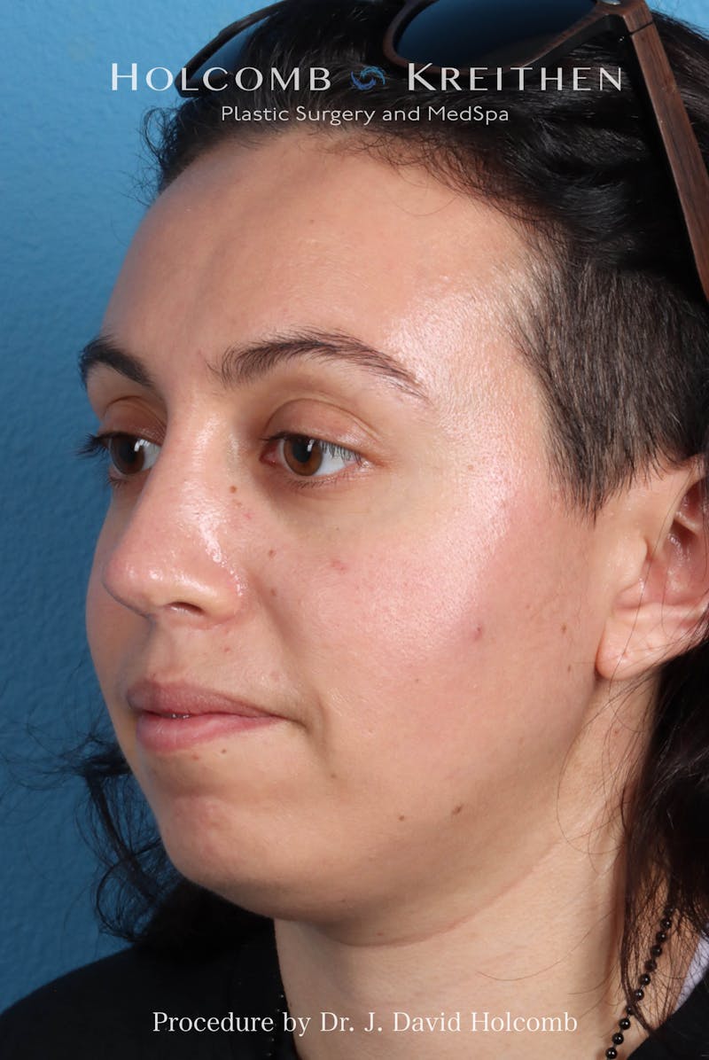 Rhinoplasty Before & After Gallery - Patient 804562 - Image 6