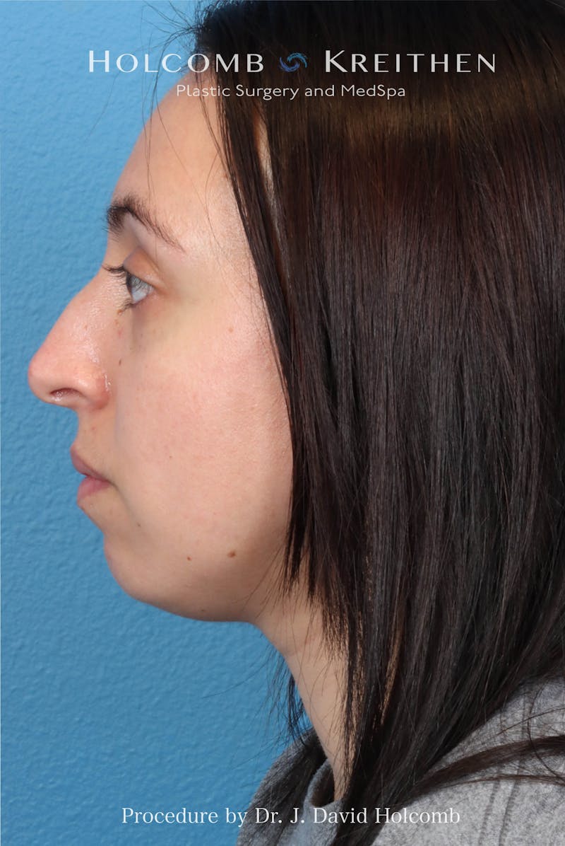 Rhinoplasty Before & After Gallery - Patient 804562 - Image 1