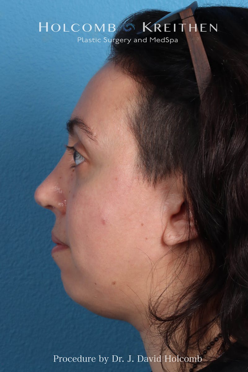 Rhinoplasty Before & After Gallery - Patient 804562 - Image 2