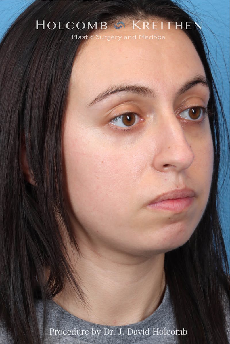 Rhinoplasty Before & After Gallery - Patient 804562 - Image 7