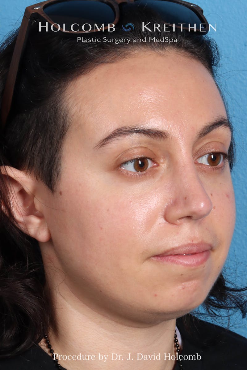 Rhinoplasty Before & After Gallery - Patient 804562 - Image 8