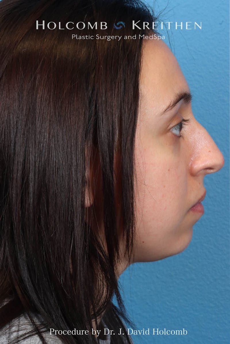Rhinoplasty Before & After Gallery - Patient 804562 - Image 9